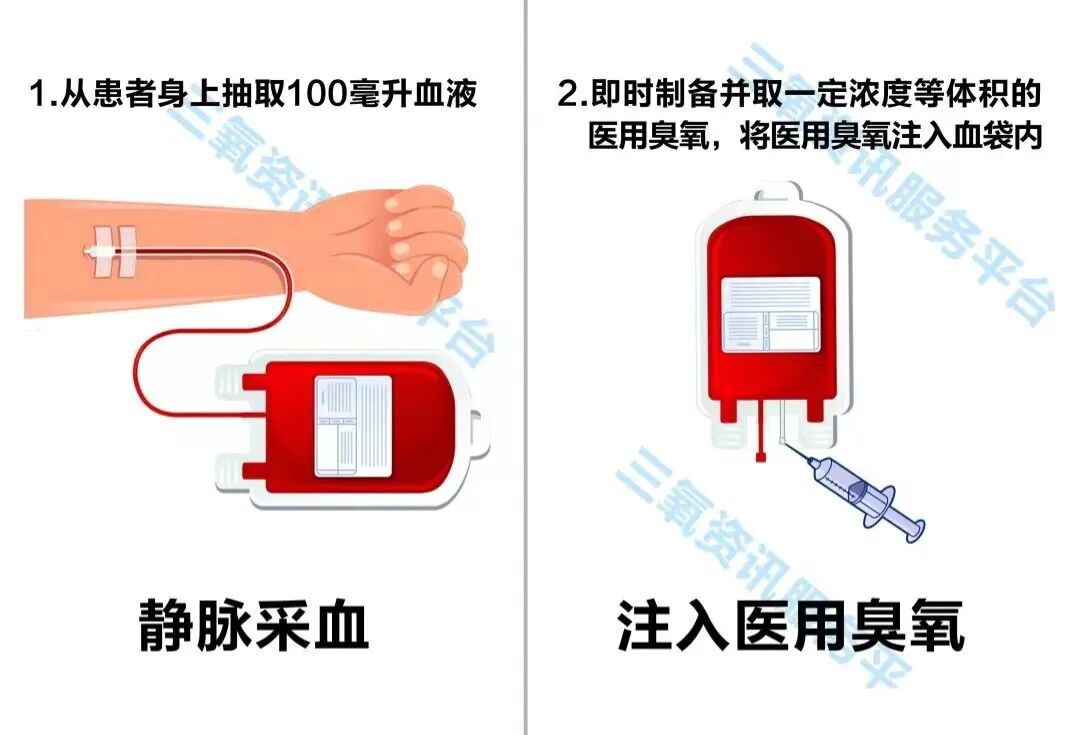 什么是臭氧大自血疗法【新技术】用自己的血救自己，我院针推科开展治疗新技术“臭氧大自血回输治疗术”_https://www.jmylbn.com_新闻资讯_第4张