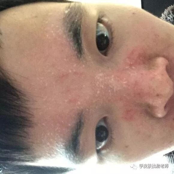【面部脂溢性皮炎】面子问题千万别“乱涂药膏”