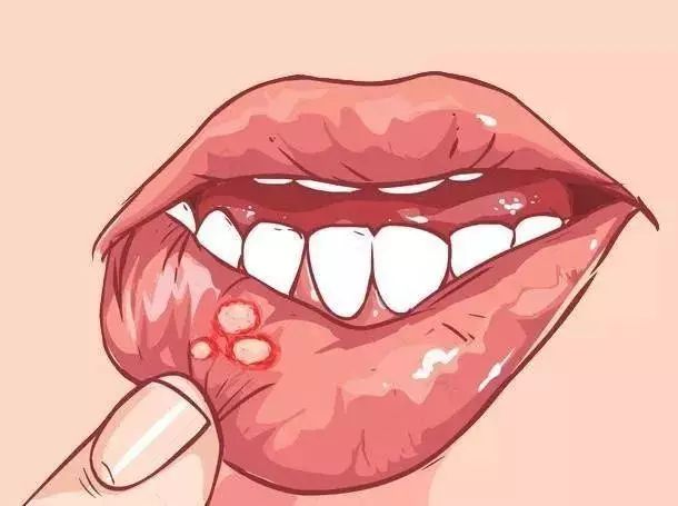 口腔溃疡、刷牙出血，上火是什么玄学？
