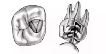 全口开髓标准图，值得收藏！