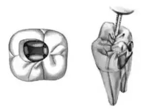 全口开髓标准图，值得收藏！