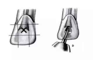 全口开髓标准图，值得收藏！