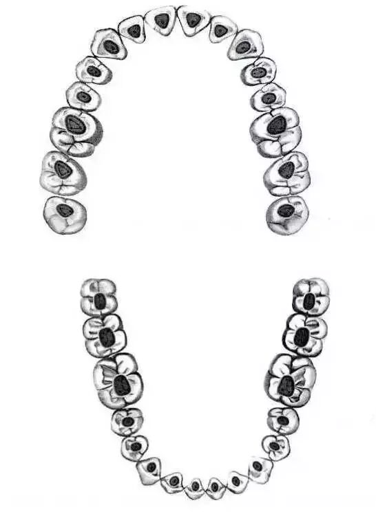 全口开髓标准图，值得收藏！