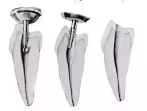 全口开髓标准图，值得收藏！