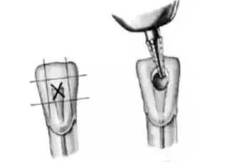 全口开髓标准图，值得收藏！