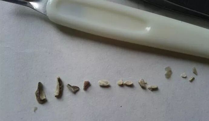 这么大块的牙结石掉了怎么办？