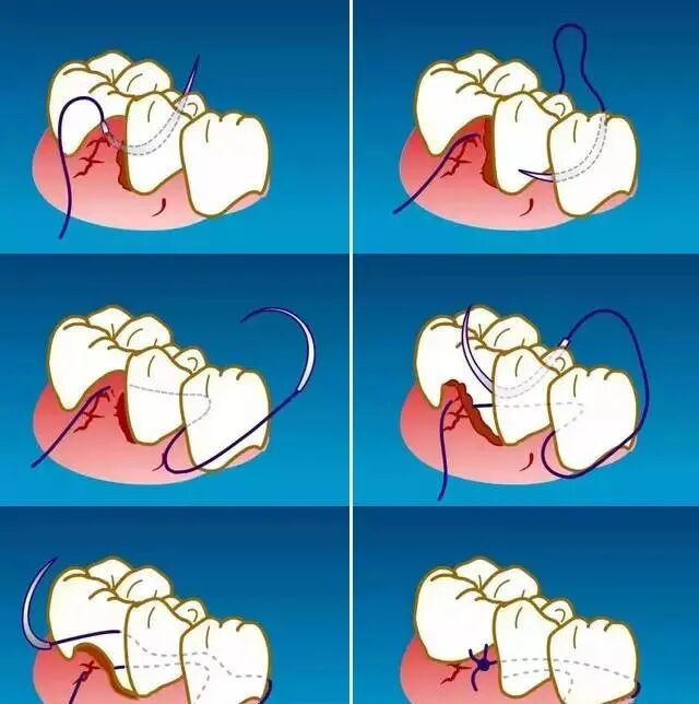 缝合针怎么选规格牙周治疗缝针、缝线选择和缝合方法_https://www.jmylbn.com_新闻资讯_第6张