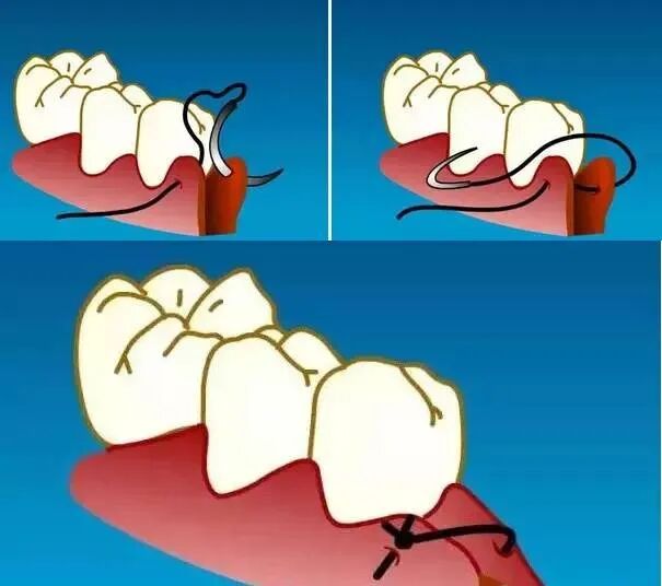 缝合针怎么选规格牙周治疗缝针、缝线选择和缝合方法_https://www.jmylbn.com_新闻资讯_第5张