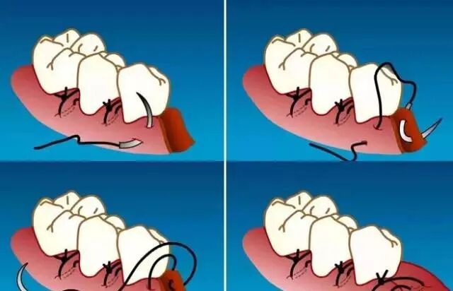 缝合针怎么选规格牙周治疗缝针、缝线选择和缝合方法_https://www.jmylbn.com_新闻资讯_第7张