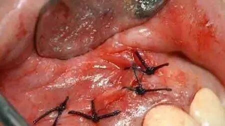 高清图文：根尖切除术操作全过程