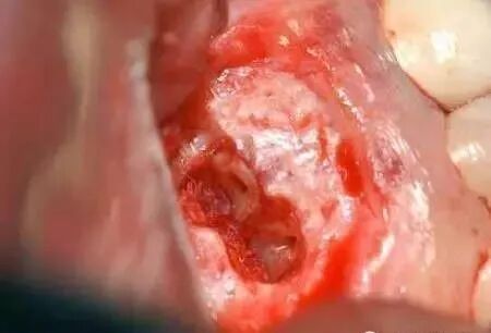 高清图文：根尖切除术操作全过程