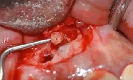 高清图文：根尖切除术操作全过程