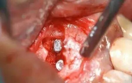 高清图文：根尖切除术操作全过程