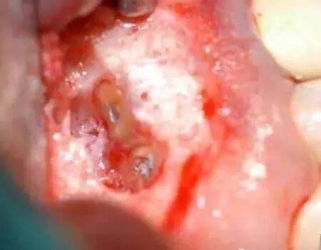 高清图文：根尖切除术操作全过程