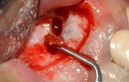 高清图文：根尖切除术操作全过程