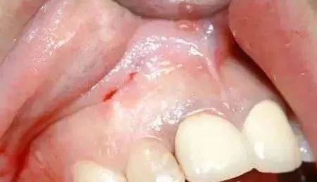 高清图文：根尖切除术操作全过程