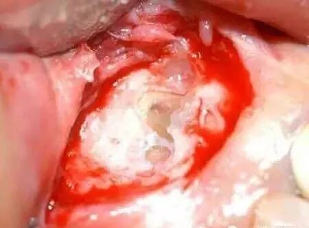 高清图文：根尖切除术操作全过程