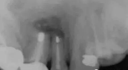 高清图文：根尖切除术操作全过程