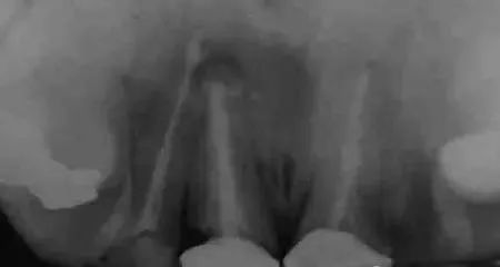 高清图文：根尖切除术操作全过程