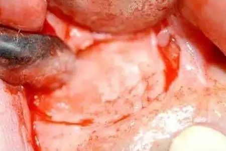 高清图文：根尖切除术操作全过程