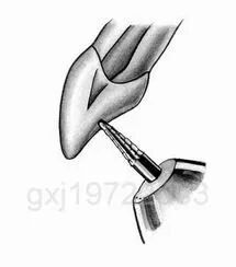 口腔H锉怎么消毒牙科医生必须看看----经典根管治疗总结_https://www.jmylbn.com_新闻资讯_第6张