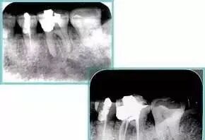 牙胶尖什么颜色最全整理 ｜ 根管治疗标准步骤和细节把握_https://www.jmylbn.com_新闻资讯_第31张