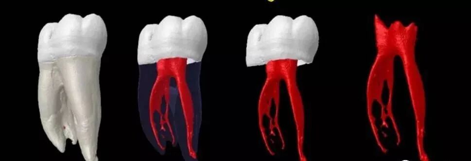 牙胶尖什么颜色最全整理 ｜ 根管治疗标准步骤和细节把握_https://www.jmylbn.com_新闻资讯_第3张