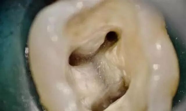 根管治疗标准步骤和细节把握