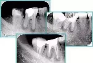 牙胶尖什么颜色最全整理 ｜ 根管治疗标准步骤和细节把握_https://www.jmylbn.com_新闻资讯_第30张