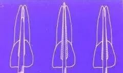 牙胶尖什么颜色最全整理 ｜ 根管治疗标准步骤和细节把握_https://www.jmylbn.com_新闻资讯_第14张