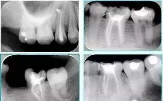牙胶尖什么颜色最全整理 ｜ 根管治疗标准步骤和细节把握_https://www.jmylbn.com_新闻资讯_第26张
