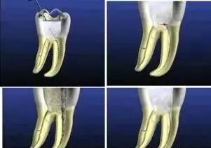 牙胶尖什么颜色最全整理 ｜ 根管治疗标准步骤和细节把握_https://www.jmylbn.com_新闻资讯_第9张