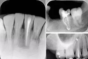 牙胶尖什么颜色最全整理 ｜ 根管治疗标准步骤和细节把握_https://www.jmylbn.com_新闻资讯_第23张