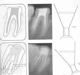 牙胶尖什么颜色最全整理 ｜ 根管治疗标准步骤和细节把握_https://www.jmylbn.com_新闻资讯_第24张