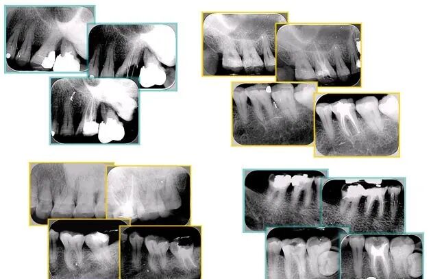 牙胶尖什么颜色最全整理 ｜ 根管治疗标准步骤和细节把握_https://www.jmylbn.com_新闻资讯_第35张