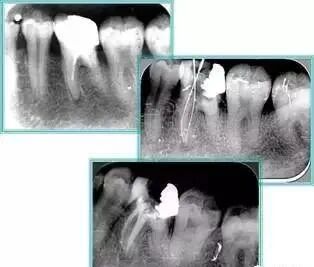牙胶尖什么颜色最全整理 ｜ 根管治疗标准步骤和细节把握_https://www.jmylbn.com_新闻资讯_第34张