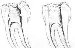 牙胶尖什么颜色最全整理 ｜ 根管治疗标准步骤和细节把握_https://www.jmylbn.com_新闻资讯_第10张