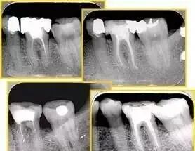 牙胶尖什么颜色最全整理 ｜ 根管治疗标准步骤和细节把握_https://www.jmylbn.com_新闻资讯_第33张