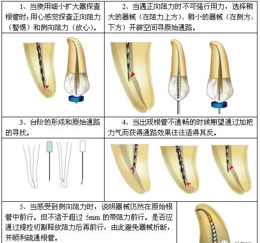 根管治疗标准步骤和细节把握