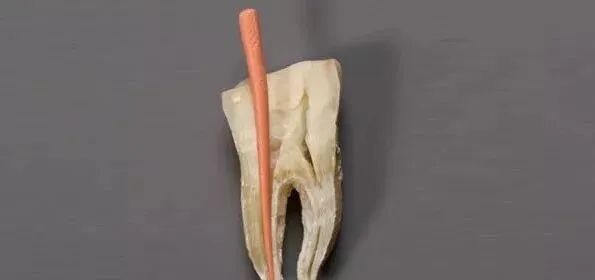 根管治疗标准步骤和细节把握