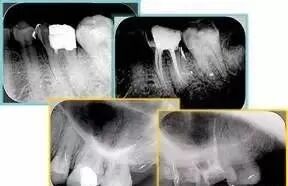 牙胶尖什么颜色最全整理 ｜ 根管治疗标准步骤和细节把握_https://www.jmylbn.com_新闻资讯_第32张