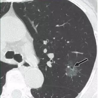 肺部小结节 肺部小结节