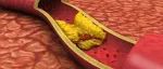 释疑｜红细胞膜上胆固醇含量与动脉粥样硬化（As）斑块的形成密切相关的理解