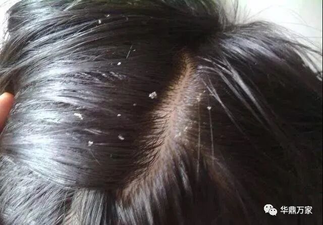 头皮上有白色的一片一片是怎么了