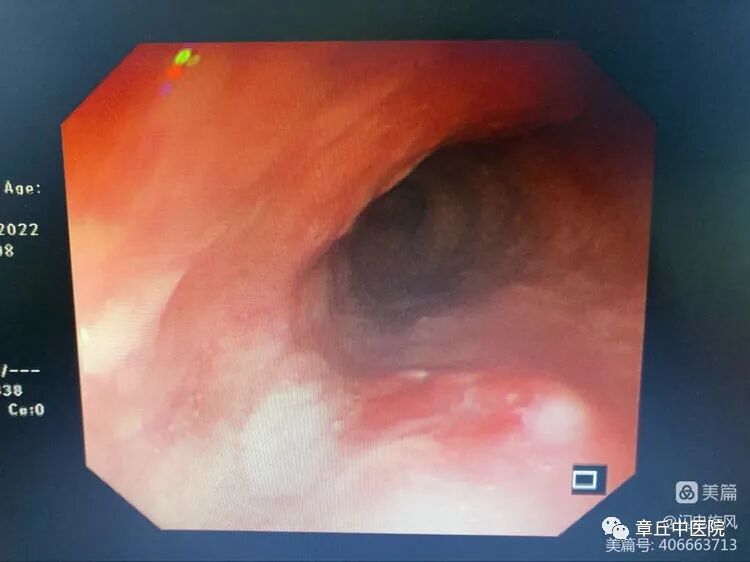 一次性活检钳检查什么脾胃肝胆病二科镜技空间——内镜下粘膜剥离术（ESD）_https://www.jmylbn.com_新闻资讯_第4张