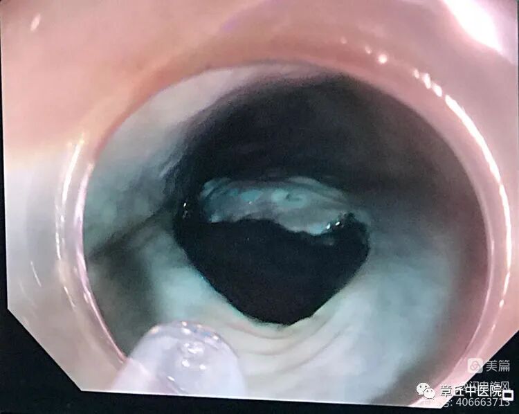 一次性活检钳检查什么脾胃肝胆病二科镜技空间——内镜下粘膜剥离术（ESD）_https://www.jmylbn.com_新闻资讯_第5张