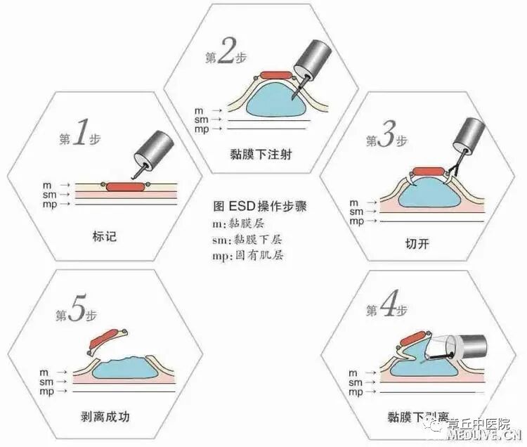 一次性活检钳检查什么脾胃肝胆病二科镜技空间——内镜下粘膜剥离术（ESD）_https://www.jmylbn.com_新闻资讯_第8张