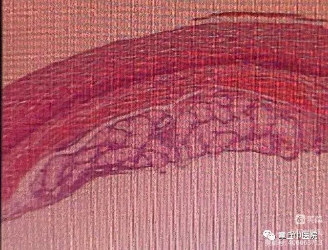 一次性活检钳检查什么脾胃肝胆病二科镜技空间——内镜下粘膜剥离术（ESD）_https://www.jmylbn.com_新闻资讯_第6张
