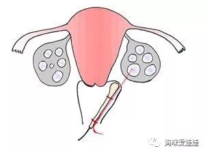 取卵针长什么样试管婴儿取卵的针有这么长长长的嘛？听说有人疼的打滚？_https://www.jmylbn.com_新闻资讯_第11张