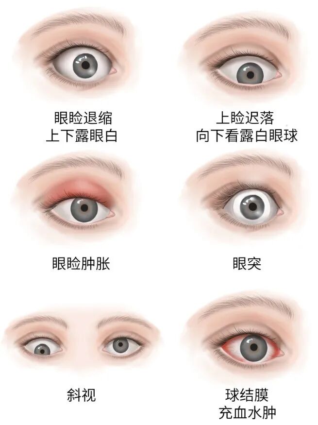 一,非浸润性突眼,又称良性突眼,单纯性突眼,表现为眼球突出,眼睛凝视